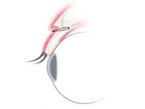 美容外科・二重まぶた 埋没法・LT法/東京皮膚科・形成外科