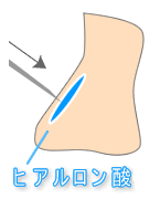美容外科・隆鼻術 ヒアルロン酸/東京皮膚科・形成外科