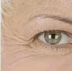 美容皮膚科・しわ治療 ヒアルロン酸注入/東京皮膚科・形成外科