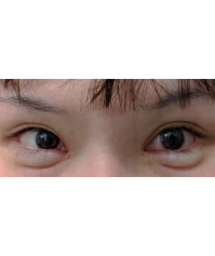 下眼瞼　グラマラスライン・涙袋形成自然癒着法2点/東京皮膚科・形成外科