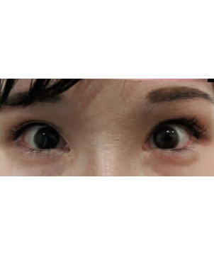 下眼瞼　グラマラスライン・涙袋形成自然癒着法2点/東京皮膚科・形成外科