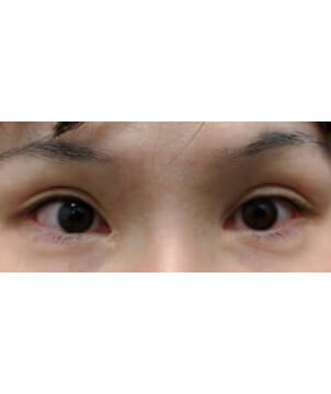 下眼瞼　グラマラスライン・涙袋形成自然癒着法2点/東京皮膚科・形成外科