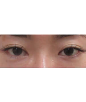 下眼瞼　グラマラスライン・涙袋形成自然癒着法2点/東京皮膚科・形成外科