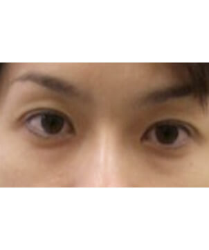 美容外科・二重まぶた 埋没法・NSLT法2点/東京皮膚科・形成外科