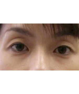 美容外科・二重まぶた 埋没法・NSLT法2点/東京皮膚科・形成外科