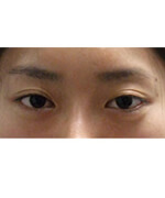 美容外科・二重まぶた 埋没法・LT法/東京皮膚科・形成外科