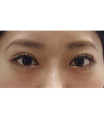 美容外科・二重まぶた 埋没法・LT法/東京皮膚科・形成外科